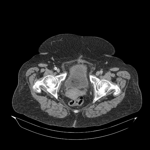 Acute superior mesenteric artery occlusion (Radiopaedia 51288-56960 Axial C+ portal venous phase 97).jpg