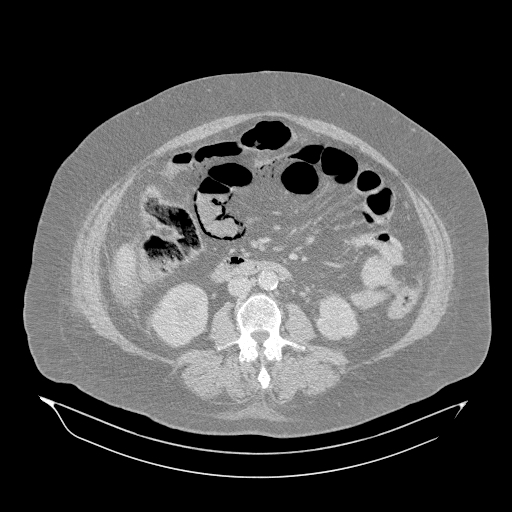 Acute superior mesenteric artery occlusion (Radiopaedia 51288-56960 Axial lung window 31).jpg