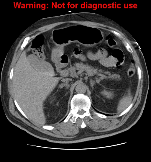 File:Acute tubular necrosis (Radiopaedia 13301).jpg