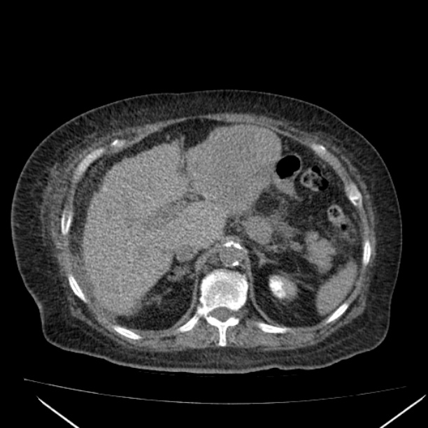 Acute tubular necrosis (Radiopaedia 28077-28334 Axial non-contrast 21).jpg