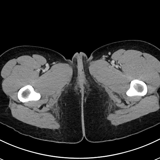 File:Acute uncomplicated appendicitis (Radiopaedia 61374-69304 Axial C+ portal venous phase 147).jpg