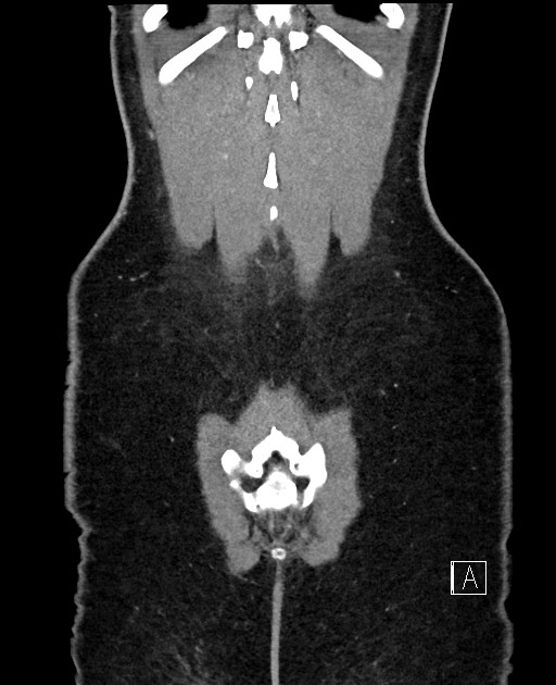 Acute uncomplicated appendicitis (Radiopaedia 61374-69304 Coronal C+ portal venous phase 98).jpg