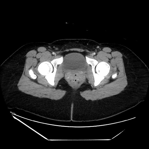 Acute uncomplicated appendicitis (Radiopaedia 73704-84499 Axial C+ portal venous phase 159).jpg
