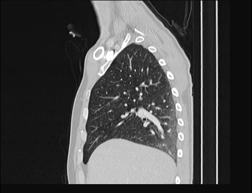 Addison disease (Radiopaedia 49318-54412 Sagittal lung window 45).jpg
