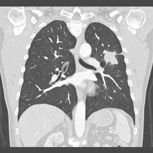 Adenocarcinoma of the lung (Radiopaedia 59871-67325 Coronal lung window 36).jpg