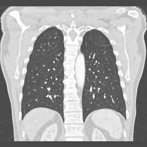 Adenocarcinoma of the lung (Radiopaedia 59871-67325 Coronal lung window 47).jpg