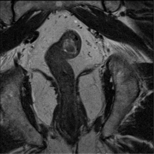 File:Adenocarcioma of rectum- T1 lesion (Radiopaedia 36921-38546 Coronal T2 9).png
