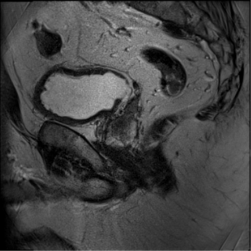 File:Adenocarcioma of rectum- T1 lesion (Radiopaedia 36921-38546 Sagittal T2 8).png