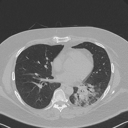 Adenoid cystic carcinoma of the trachea (Radiopaedia 49042-54137 Axial lung window 204).jpg