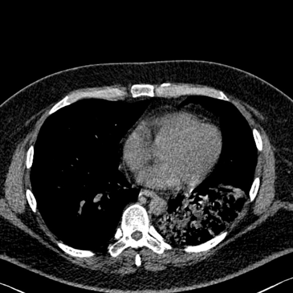 Adenoid cystic carcinoma of the trachea (Radiopaedia 49042-54137 Axial non-contrast 222).jpg