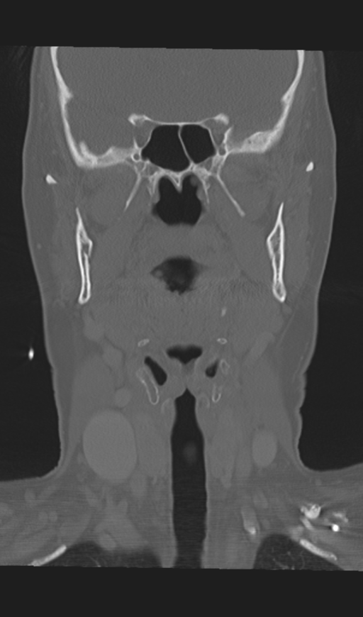 Adenoid cystic tumor of palate (Radiopaedia 46980-51518 Coronal bone window 31).png