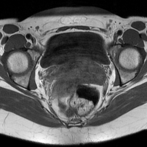 File:Adenoma malignum of cervix (Radiopaedia 66441-75705 Axial T1 11).jpg