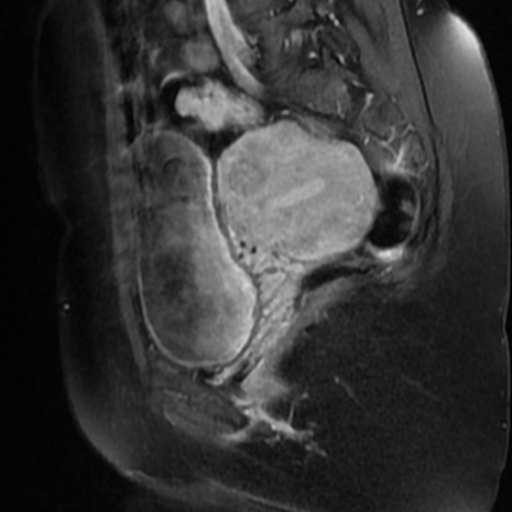 File:Adenoma malignum of cervix (Radiopaedia 66441-75705 Sagittal T1 C+ fat sat 7).jpg