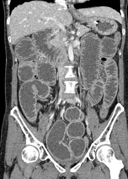 File:Adhesional small bowel obstruction (Radiopaedia 48397-53305 Coronal C+ portal venous phase 173).jpg