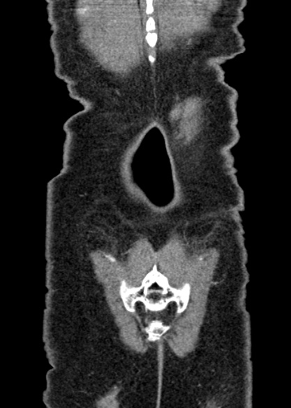 Adhesional small bowel obstruction (Radiopaedia 48397-53305 Coronal C+ portal venous phase 333).jpg