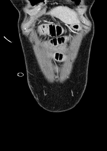 Adhesional small bowel obstruction (Radiopaedia 48397-53305 Coronal C+ portal venous phase 41).jpg