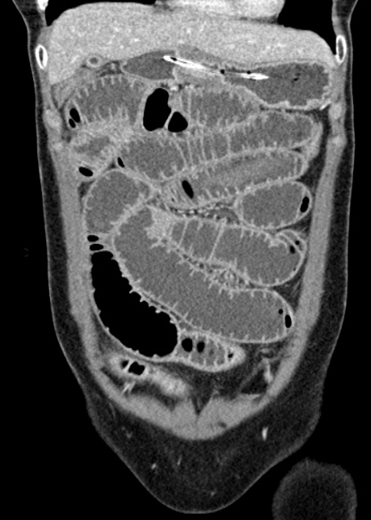 Adhesional small bowel obstruction (Radiopaedia 48397-53305 Coronal C+ portal venous phase 91).jpg