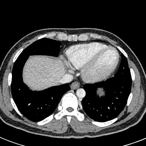 File:Adhesional small bowel obstruction (Radiopaedia 58900-66131 Axial C+ portal venous phase 4).jpg
