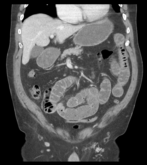 Adhesions within abdominal wall hernia (Radiopaedia 58283-65394 Coronal C+ portal venous phase 30).png