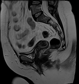 File:Adnexal multilocular cyst (O-RADS US 3- O-RADS MRI 3) (Radiopaedia 87426-103754 Sagittal T2 11).jpg