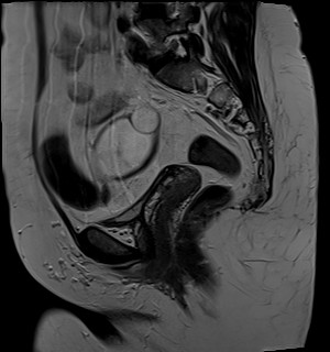 File:Adnexal multilocular cyst (O-RADS US 3- O-RADS MRI 3) (Radiopaedia 87426-103754 Sagittal T2 15).jpg