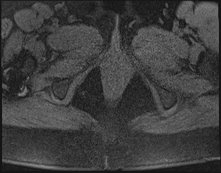 File:Adnexal multilocular cyst (O-RADS US 3. O-RADS MRI 3) (Radiopaedia 87426-103754 Axial 224).jpeg
