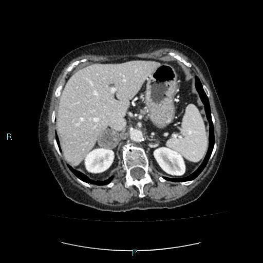 File:Adrenal collision tumor (ACT) (Radiopaedia 48462-53379 Axial C+ portal venous phase 13).jpg