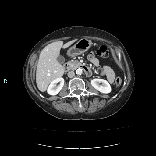 File:Adrenal collision tumor (ACT) (Radiopaedia 48462-53379 Axial C+ portal venous phase 26).jpg
