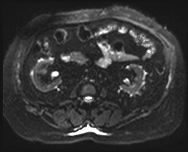 Adrenal cortical carcinoma (Radiopaedia 64017-72770 Axial DWI 27).jpg