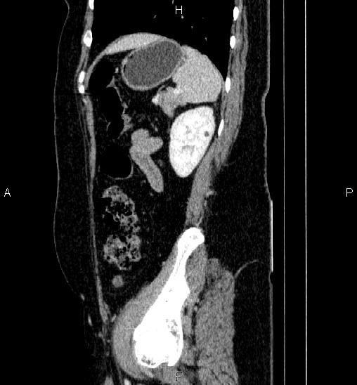 File:Adrenal cortical carcinoma (Radiopaedia 84882-100379 Sagittal C+ portal venous phase 69).jpg