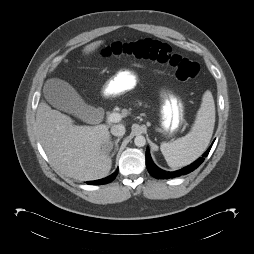 Adrenal cyst (Radiopaedia 45625-49776 Axial C+ portal venous phase 27).png