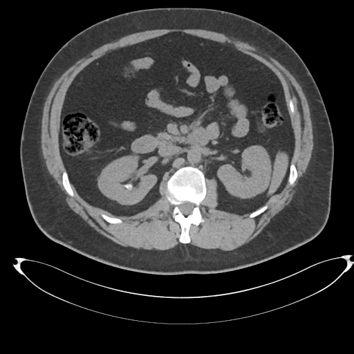 Adrenal cyst (Radiopaedia 45625-49778 Axial non-contrast 46).png