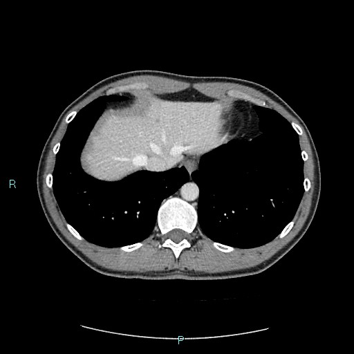 Adrenal cystic lymphangioma (Radiopaedia 83161-97534 Axial C+ portal venous phase 13).jpg