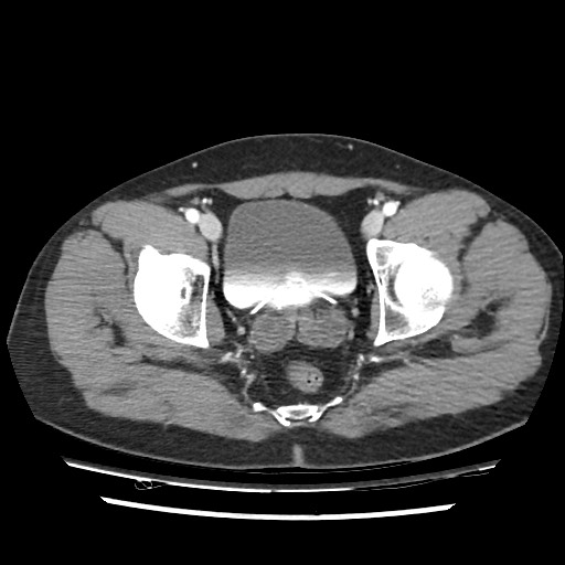 Adrenal gland trauma (Radiopaedia 81351-95078 Axial Dual bolus trauma C+ 114).jpg