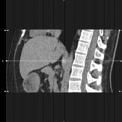 Adrenal gland trauma (Radiopaedia 81351-95079 Coronal non-contrast 1).jpg