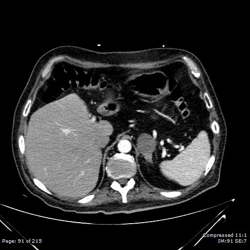 Adrenal metastasis (Radiopaedia 78425-91079 Axial C+ arterial phase 21).jpg