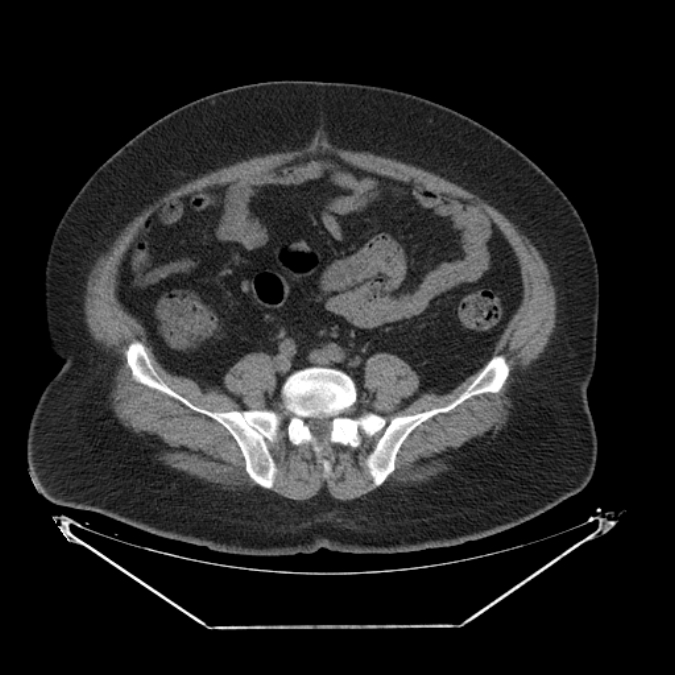Adrenal myelolipoma (Radiopaedia 26278-26407 Axial non-contrast 50).jpg