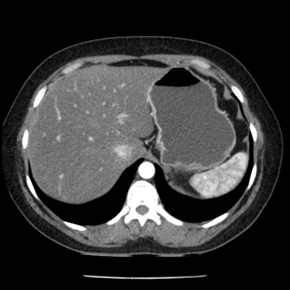 Adrenal myelolipoma (Radiopaedia 43401-46759 Axial C+ arterial phase 17).jpg
