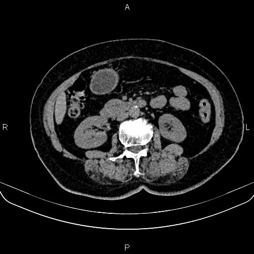 Adrenal myelolipoma (Radiopaedia 82742-96986 Axial non-contrast 76).jpg