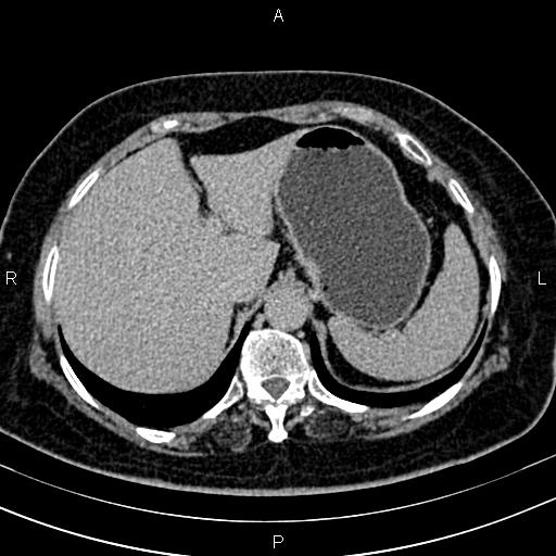 Adrenal myelolipoma (Radiopaedia 82742-96986 Axial renal excretory phase 24).jpg