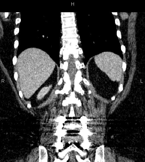 Adrenal myelolipoma (Radiopaedia 84319-99617 Coronal renal cortical phase 63).jpg