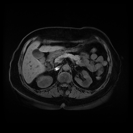 Adrenal myelolipoma - MRI (Radiopaedia 83249-97646 Axial T1 fat sat 34).jpg