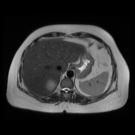 File:Adrenal myelolipoma - MRI (Radiopaedia 83249-97646 Axial T2 8).jpg