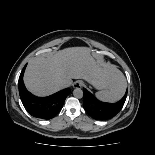 Adrenal myelolipoma and beaver tail liver (Radiopaedia 86201-102193 Axial non-contrast 56).jpg