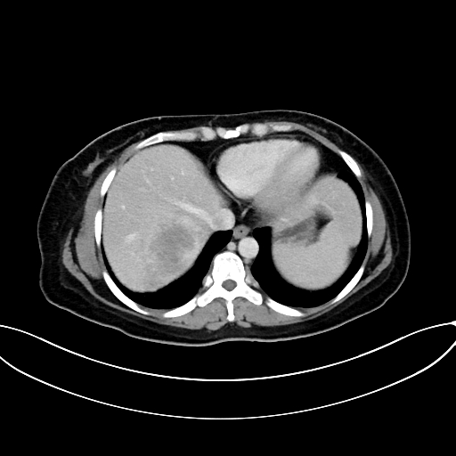 Adrenocortical carcinoma (Radiopaedia 87281-103569 Axial C+ portal venous phase 13).jpg