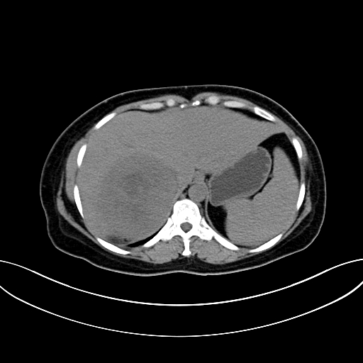 Adrenocortical carcinoma (Radiopaedia 87281-103569 Axial non-contrast 18).jpg