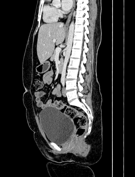 Adrenocortical carcinoma (Radiopaedia 87281-103569 Sagittal C+ portal venous phase 157).jpg