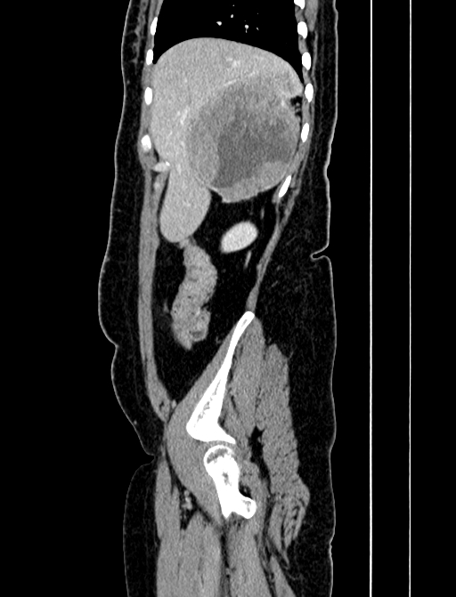 Adrenocortical carcinoma (Radiopaedia 87281-103569 Sagittal C+ portal venous phase 42).jpg