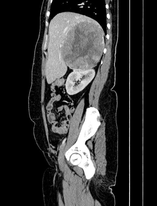Adrenocortical carcinoma (Radiopaedia 87281-103569 Sagittal C+ portal venous phase 77).jpg