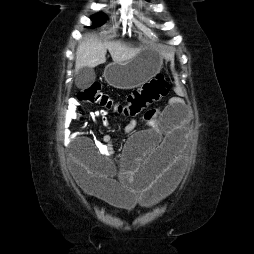 File:Afferent loop syndrome - secondary to incarcerated trocar site hernia (Radiopaedia 82959-97305 Coronal C+ portal venous phase 45).jpg